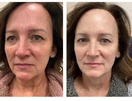 IPL Photofacial before and after results